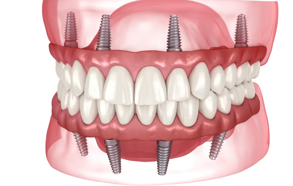 all on 4 all on 6 dentistes ollioules all on 4 all on 6 dentistes ollioules All on 4 / All on 6 Dentistes Ollioules | Cabinet dentaire Mermoz