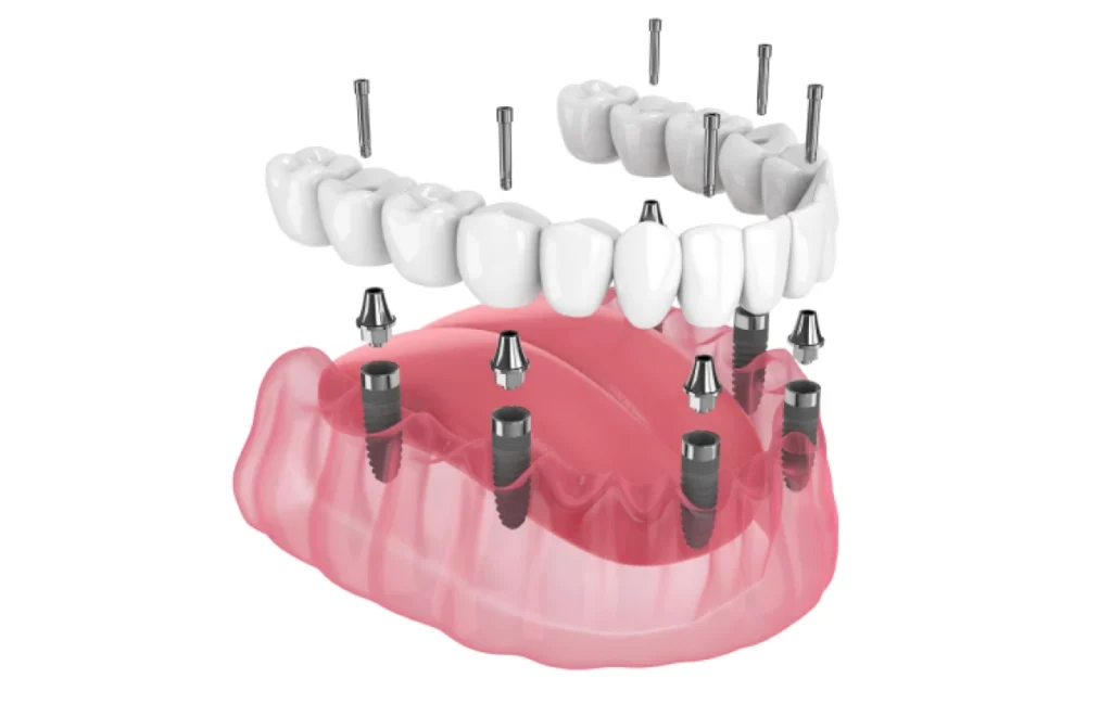 all on 4 dentistes ollioules all on 4 dentistes ollioules All on 4 / All on 6 Dentistes Ollioules | Cabinet dentaire Mermoz