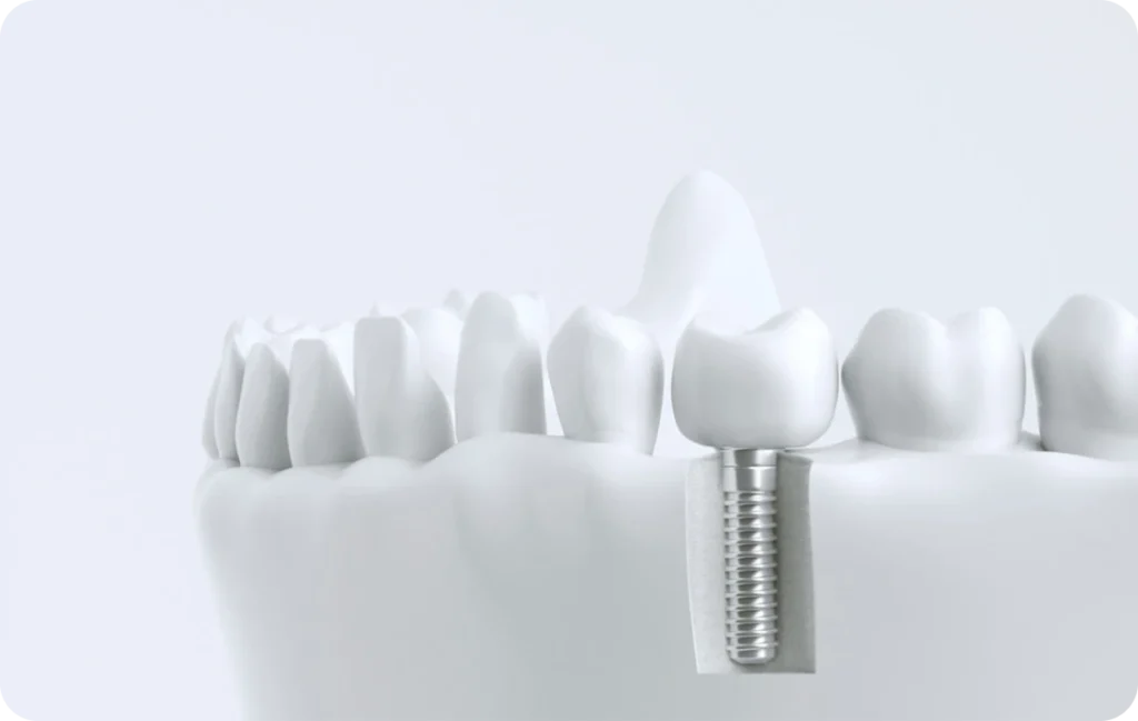 implant dentaire dentistes ollioules implant dentaire dentistes ollioules Dentiste Six Fours Dentistes Ollioules | Cabinet dentaire Mermoz