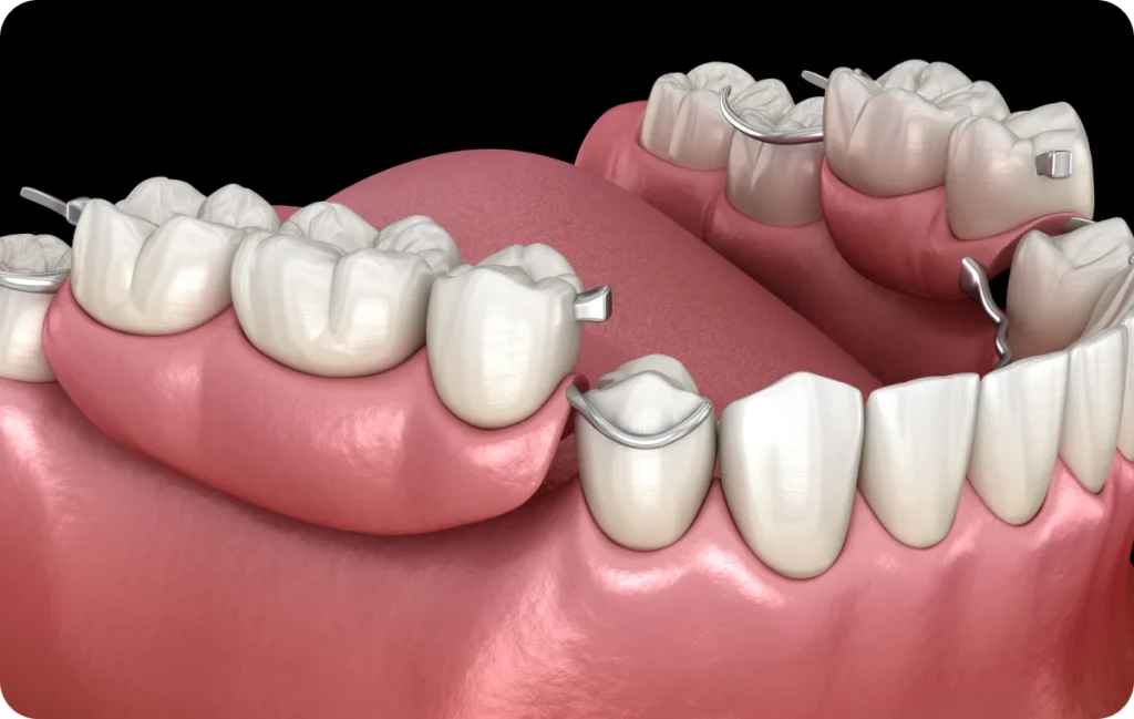 bridges dentistes ollioules bridges dentistes ollioules Bridge Dentistes Ollioules | Cabinet dentaire Mermoz
