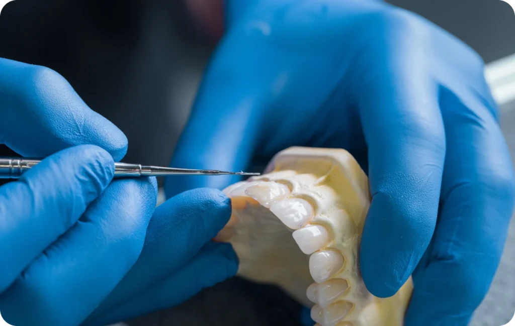 couronnes ceramiques dentistes ollioules couronnes ceramiques dentistes ollioules Inlay / onlay Dentistes Ollioules | Cabinet dentaire Mermoz