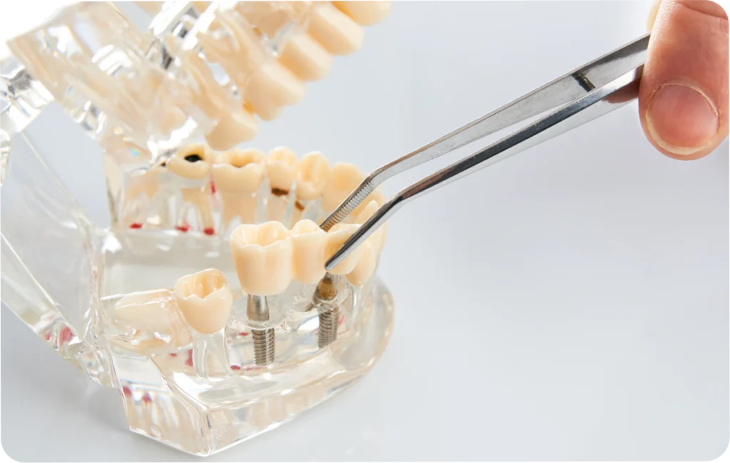dentiste bridge dentaire ollioules Bridge Dentistes Ollioules | Cabinet dentaire Mermoz