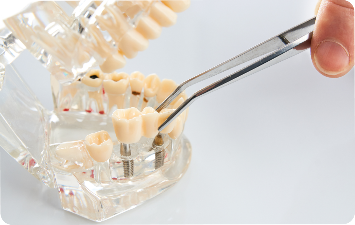 dentiste bridge dentaire ollioules Bridge Dentistes Ollioules | Cabinet dentaire Mermoz