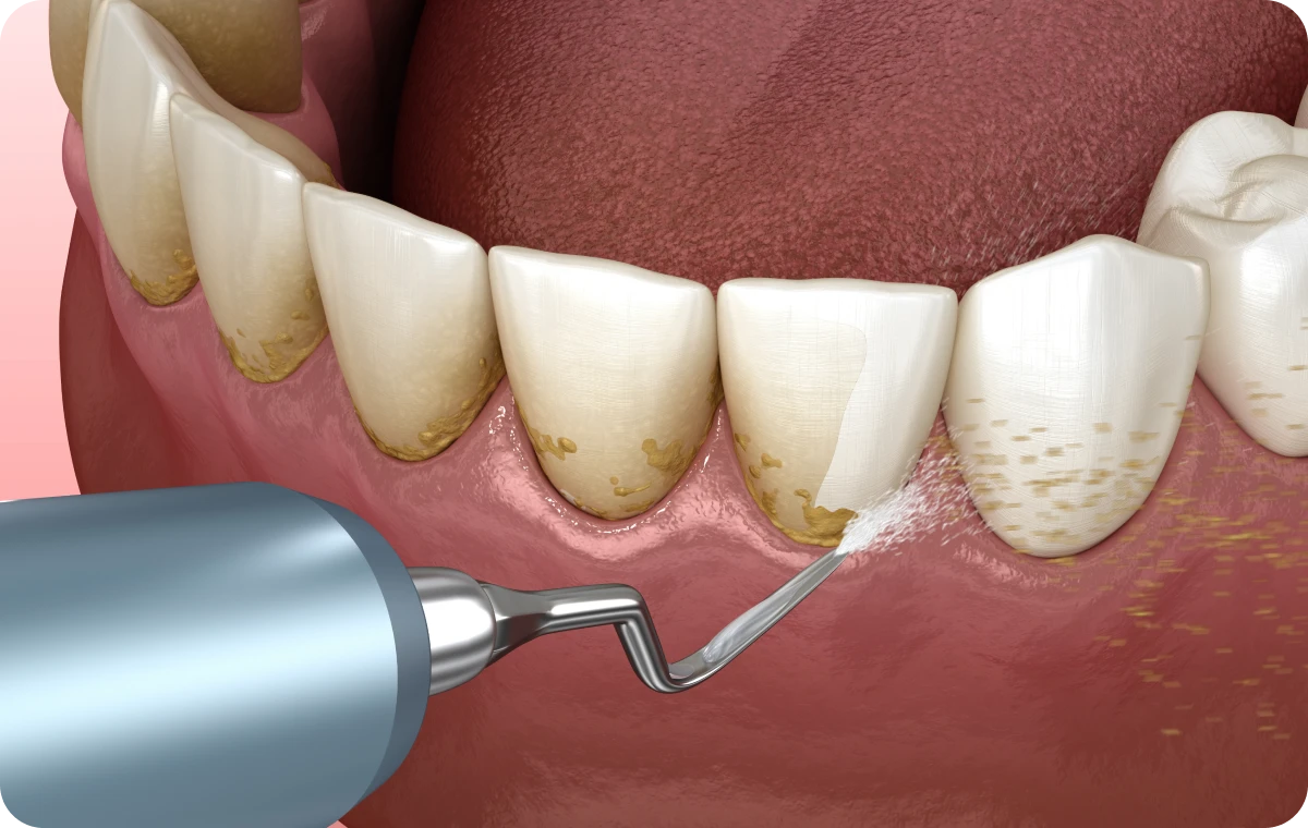 detartrage dentistes ollioules Détartrage Dentistes Ollioules | Cabinet dentaire Mermoz