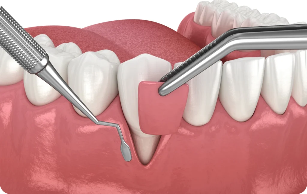 greffe gingivale dentistes ollioules greffe gingivale dentistes ollioules Greffe de gencive Dentistes Ollioules | Cabinet dentaire Mermoz