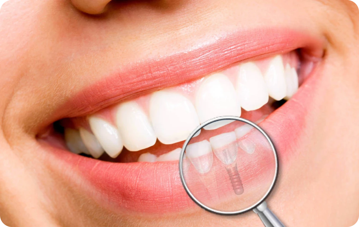 implant dentaire dentistes six fours Dentistes Ollioules | Cabinet dentaire Mermoz