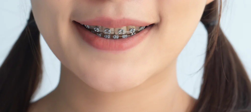 appareils dentaires Appareils orthodontiques fixes Dentistes Ollioules | Cabinet dentaire Mermoz