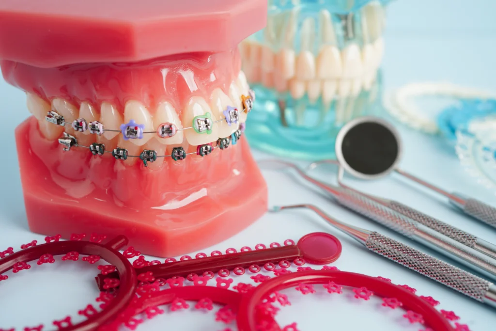 elastiques dentaires bagues Appareils orthodontiques fixes Dentistes Ollioules | Cabinet dentaire Mermoz