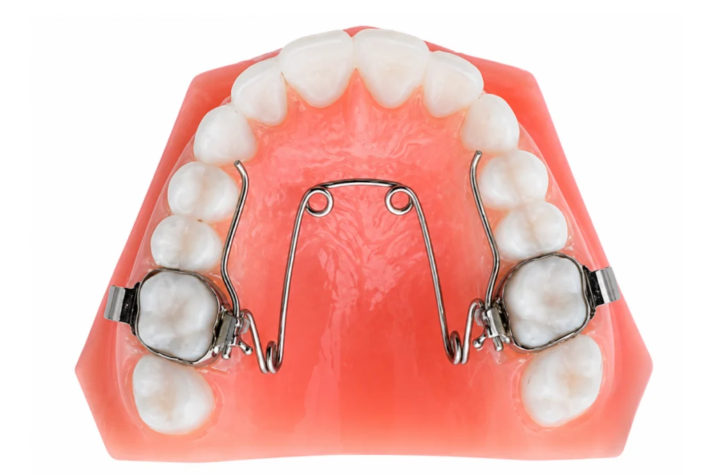 image 7 Appareils orthodontiques fixes Dentistes Ollioules | Cabinet dentaire Mermoz